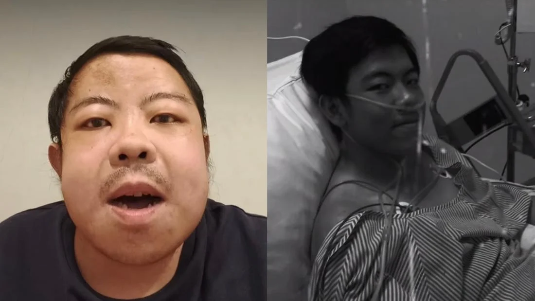 The Silent Threat: How Autoimmune Disease Forced a Jakarta Teenager Into Lifelong Dialysis
